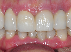 After Treatment